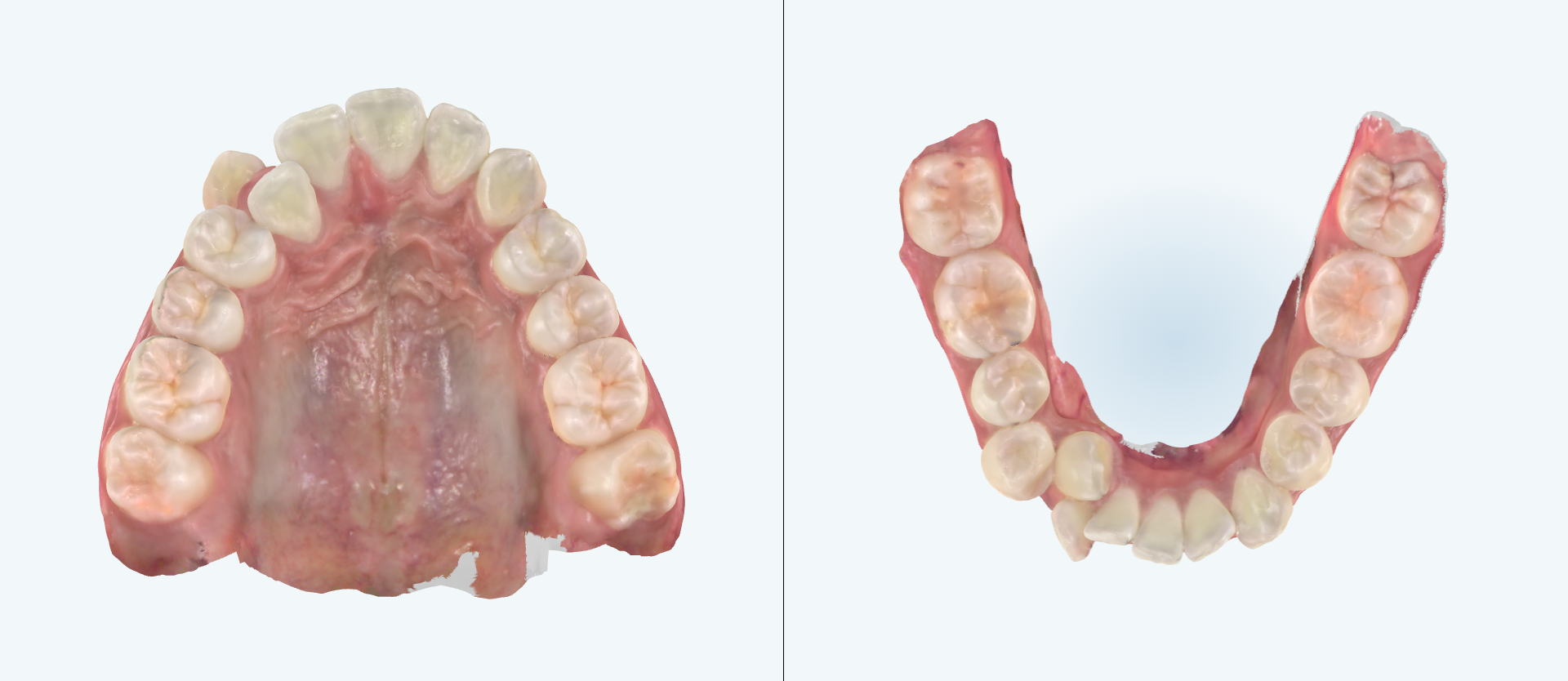 Crowding treatment comparison case 3 before